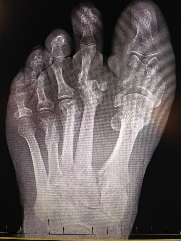 Brodsky stage 5 Charcot arthropathy